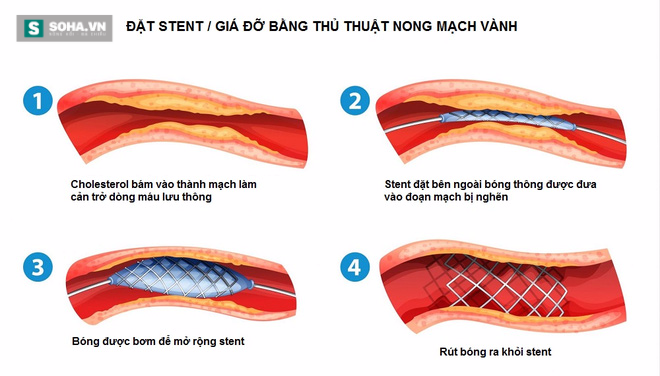 6 thực phẩm đặc trị dành cho người sợ bệnh tắc nghẽn mạch máu - Ảnh 1.