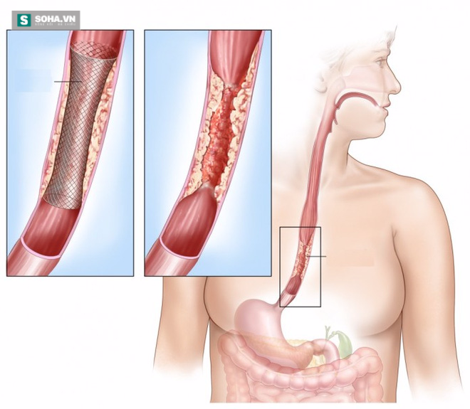 Nguy cơ rước ung thư thực quản từ thói quen nhiều người mắc - Ảnh 2.