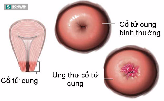 Bác sĩ cảnh báo: Muốn không mắc ung thư nguy hiểm, hãy chung tình - Ảnh 1.