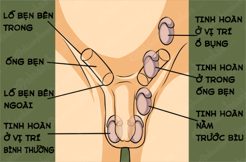 Bệnh ẩn tinh hoàn có thể gây vô sinh, ung thư cho bé trai - Ảnh 2.