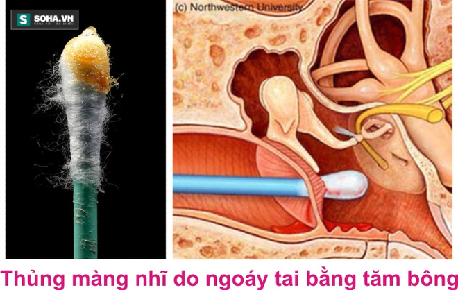 Thói quen ngoáy, lấy ráy tai suốt ngày có thể khiến bạn bị điếc - Ảnh 1.