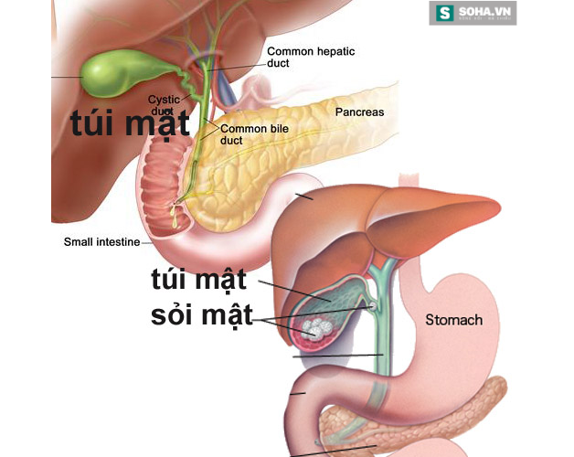 Bé gái có 25 viên sỏi mật chỉ vì thói quen ăn vặt ở cổng trường - Ảnh 4.