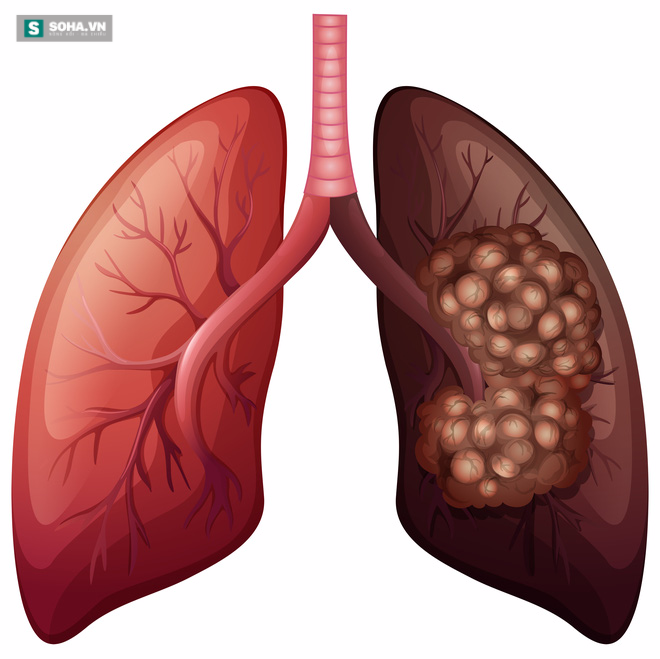 Những dấu hiệu cảnh báo sớm bệnh ung thư phổi bạn cần nắm rõ - Ảnh 1.