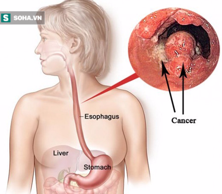 4 thói quen ăn uống là mầm họa ung thư thực quản - Ảnh 1.