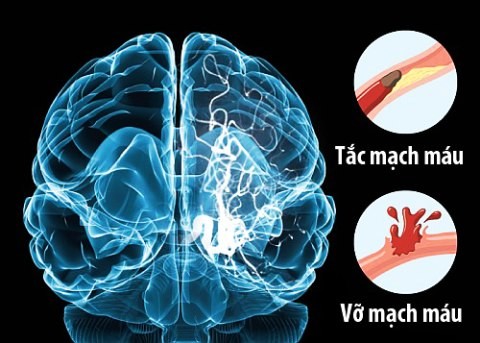 Những điều cần biết về tử thần mang tên “đột quỵ’ - Ảnh 2.