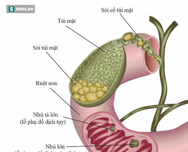 Người có thói quen ăn uống xấu này nguy cơ mắc sỏi mật rất cao - Ảnh 3.