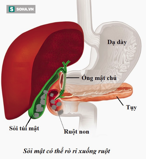 Người có thói quen ăn uống xấu này nguy cơ mắc sỏi mật rất cao - Ảnh 2.