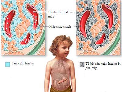 Tiểu đường: Bệnh hiểm đã tấn công cả trẻ em - Ảnh 1.