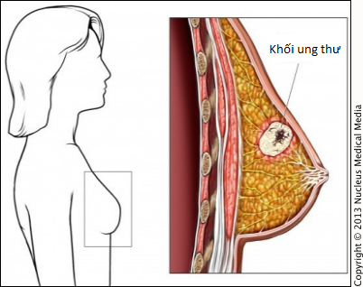 Chuyên gia ung thư khuyên nên tránh xa 4 tác nhân gây ung thư vú - Ảnh 1.