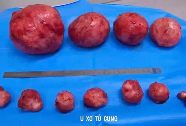 Phụ nữ Việt coi chừng phải cắt tử cung, vô sinh vì u xơ - Ảnh 1.