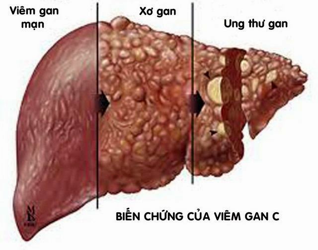 Từ viêm gan đến ung thư: Chỉ mất 3 bước - Ảnh 2.