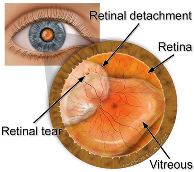 Cảnh báo biến chứng của tật khúc xạ có thể gây nguy hiểm cho mắt - Ảnh 1.