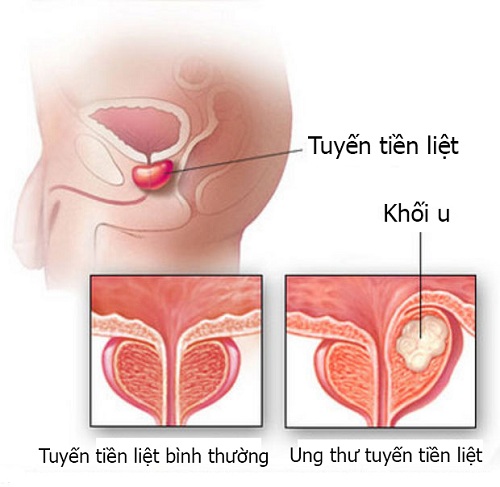 6 nhầm lẫn tai hại quý ông nào cũng mắc phải trong việc chẩn đoán ung thư - Ảnh 1.