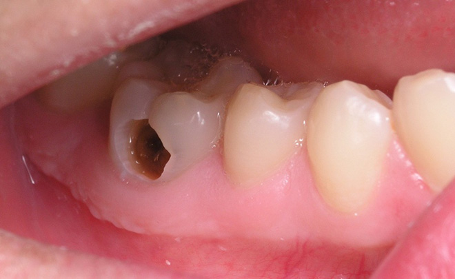 Dù rất chịu khó đánh răng, nhưng 6 nguyên nhân sau khiến miệng vẫn bị hôi - Ảnh 2.