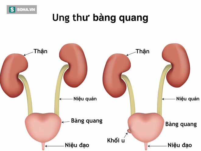 6 nhầm lẫn tai hại quý ông nào cũng mắc phải trong việc chẩn đoán ung thư - Ảnh 4.