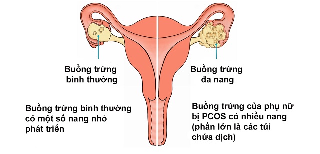 1/5 phụ nữ mắc căn bệnh dễ dẫn đến vô sinh mà không biết: 6 dấu hiệu nhận biết bệnh  - Ảnh 4.