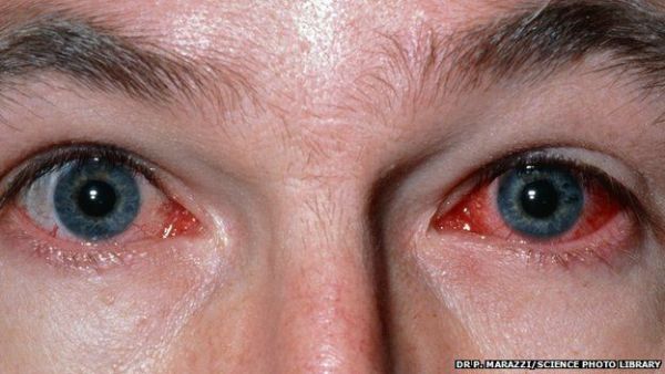 Cảnh báo: Cô gái trẻ mù một mắt vì thói quen sử dụng kính áp tròng nhiều người mắc phải - Ảnh 6.