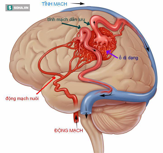 Đau đầu có thể là dấu hiệu căn bệnh gây tử vong nhanh đe doạ nhiều người trẻ - Ảnh 1.