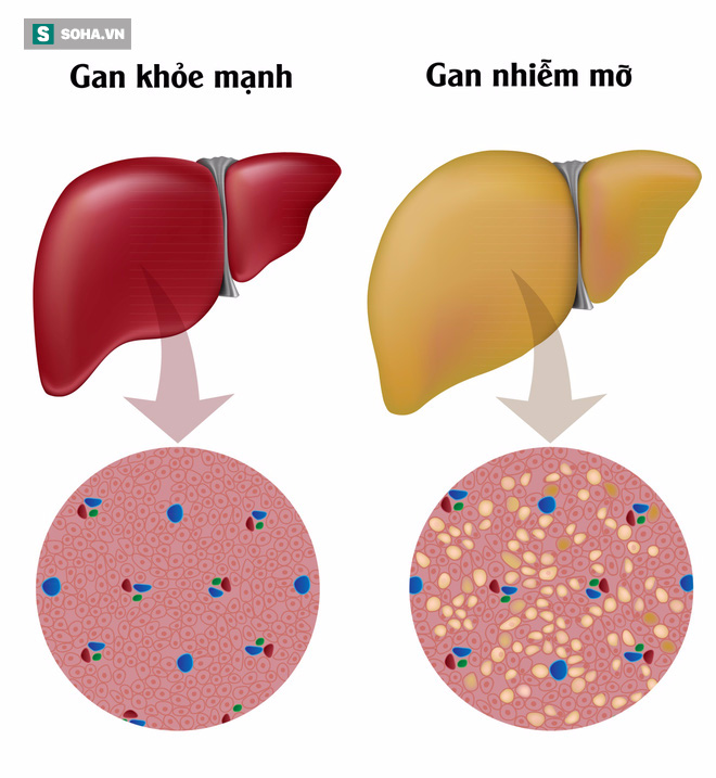 6 món trà dễ làm giải độc gan, tiêu mỡ gan hiệu quả - Ảnh 1.