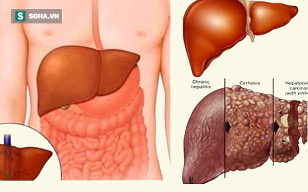 Bài thuốc bổ gan rất đơn giản từ tỏi và mật ong: Nhà nào cũng nên có sẵn - Ảnh 1.