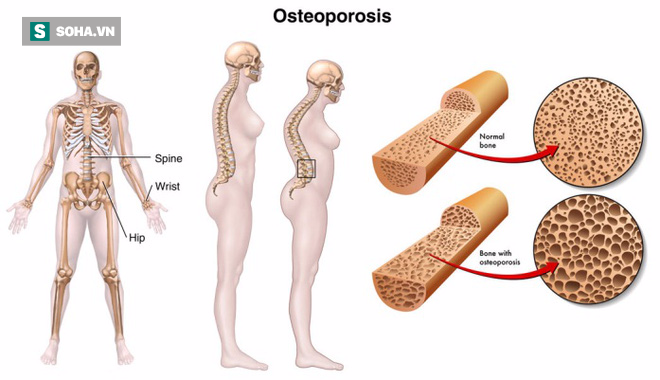 Bác sĩ tiết lộ cách chống loãng xương khoa học: Có thể lâu nay bạn đang làm sai - Ảnh 2.