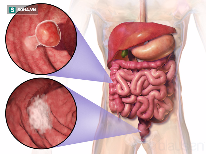 Ung thư vì bỏ qua triệu chứng suốt 10 năm: Bác sĩ chỉ rõ 3 dấu hiệu chớ coi thường - Ảnh 3.