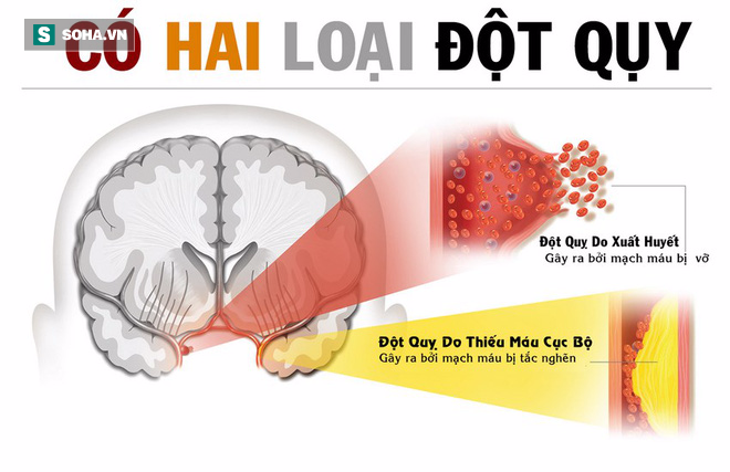 Những dấu hiệu sớm cảnh báo đột quỵ não: Ai cũng cần ghi nhớ kẻo lúc mắc không kịp cứu - Ảnh 1.