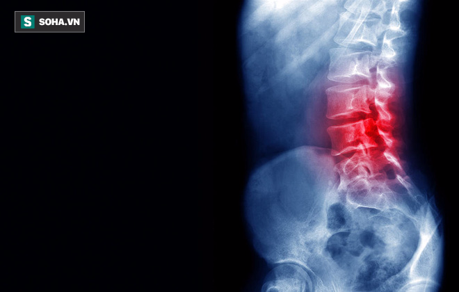 5 căn bệnh nguy hiểm đằng sau mỗi cơn đau lưng: Đừng chủ quan! - Ảnh 1.