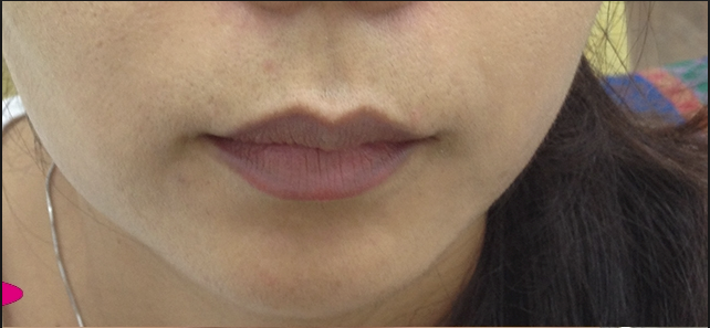 Đôi môi là cửa sổ của sức khỏe: Hãy xem môi bạn cảnh báo bệnh gì để khắc phục sớm - Ảnh 7.