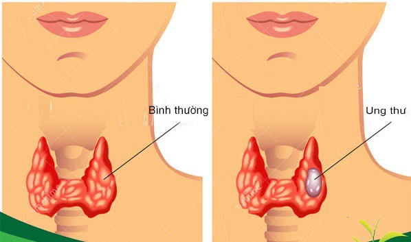 20 triệu người Mỹ mắc bệnh tuyến giáp: Hiểu rõ suy giáp, cường giáp và ung thư tuyến giáp - Ảnh 2.