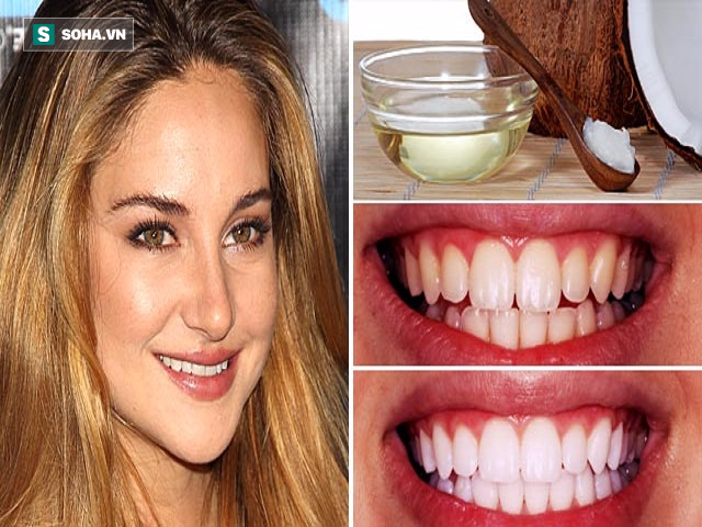4 phương pháp giúp răng trắng lên trông thấy chỉ trong 7 ngày mà không cần gặp bác sĩ - Ảnh 1.