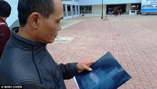 Bác sĩ Việt Nam bỏ quên kéo trong bụng bệnh nhân 18 năm khiến báo chí nước ngoài xôn xao - Ảnh 1.