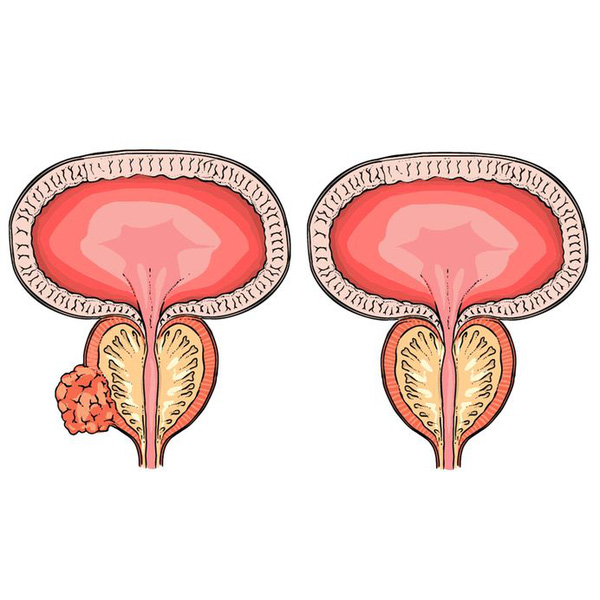 7 thực phẩm chống lại bệnh ung thư phổ biến nhất ở nam giới - Ảnh 1.