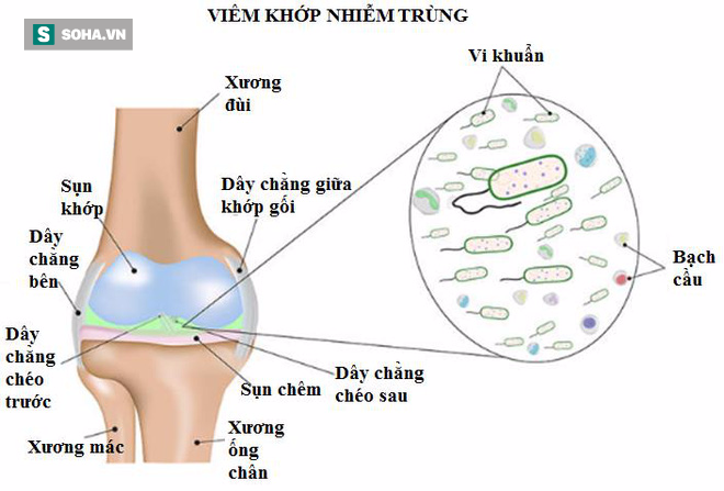 Đau nhức xương khớp đừng chủ quan: Đây có thể là nguyên nhân của 6 căn bệnh nguy hiểm - Ảnh 1.