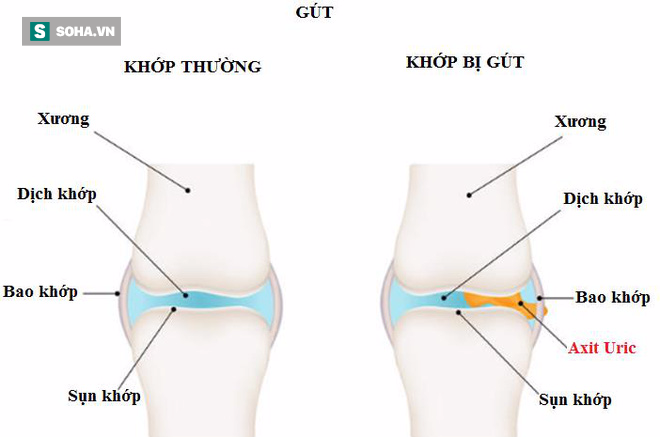 Đau nhức xương khớp đừng chủ quan: Đây có thể là nguyên nhân của 6 căn bệnh nguy hiểm - Ảnh 2.