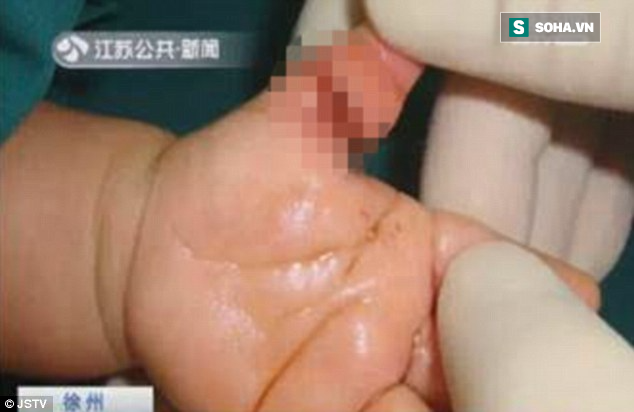 Bé sơ sinh suýt bị hoại tử ngón tay chỉ vì một sợi tóc mỏng manh của mẹ - Ảnh 2.