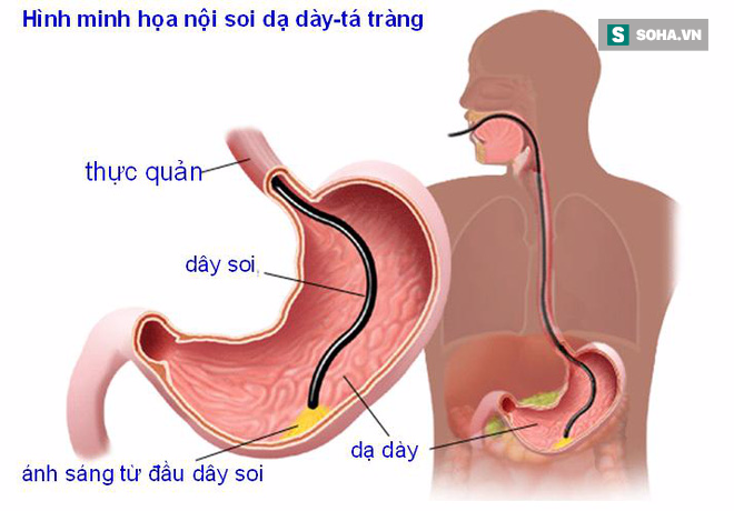 Chuyên gia cảnh báo 4 nguyên nhân gây ung thư dạ dày: Biết càng sớm phòng càng hiệu quả - Ảnh 3.