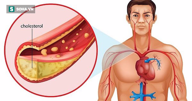 Nếu có tỉ lệ chất này trong cơ thể cao, bạn có nguy cơ cao bị đột quỵ, nhồi máu cơ tim - Ảnh 2.