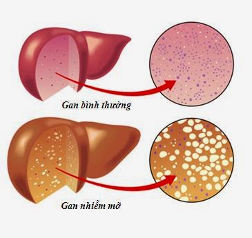 Trẻ nhỏ đã mắc gan nhiễm mỡ, dấu hiệu phát hiện sớm bệnh này - Ảnh 1.