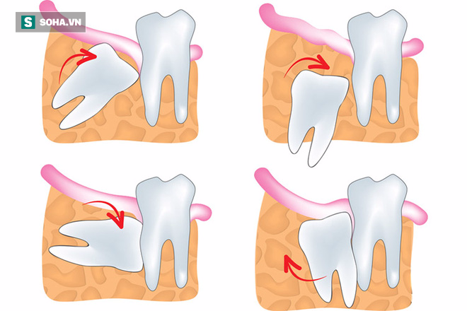 Răng khôn: Mỗi lần mọc lại một lần đau, khi nào nên nhổ? - Ảnh 2.