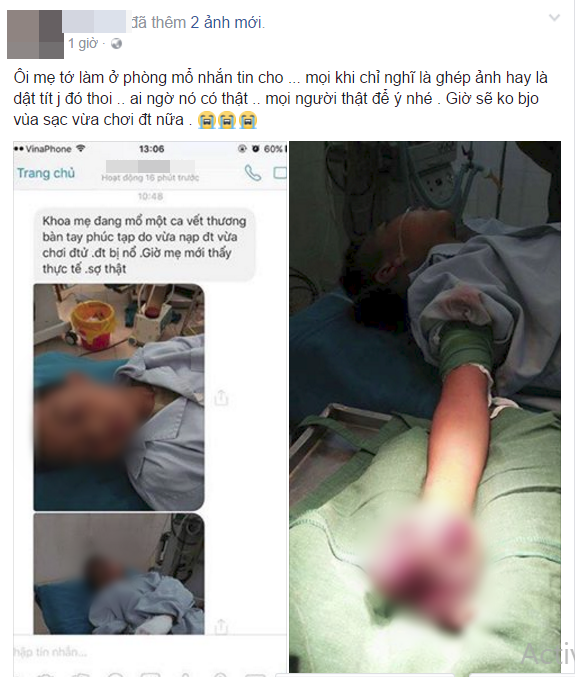 Vừa sạc pin vừa chơi game trên điện thoại, bé trai 8 tuổi bị dập nát cả bàn tay phải - Ảnh 1.