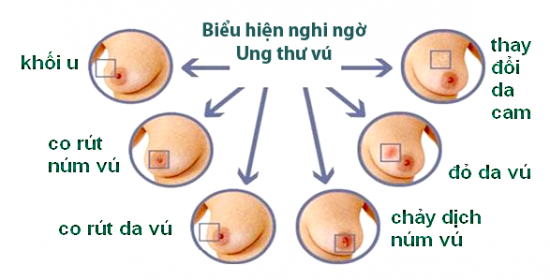 Giáo sư ung thư nổi tiếng của Pháp tiết lộ chìa khoá vàng để chữa ung thư vú - Ảnh 1.