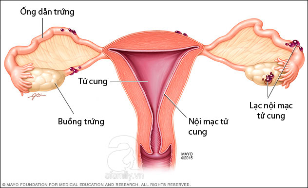 Bệnh này rất phổ biến ở phụ nữ nhưng nhiều người phải sau 10 lần đi khám mới phát hiện ra - Ảnh 1.