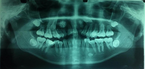 14 tuổi vẫn còn răng sữa, đi khám phát hiện u răng với hàng chục chiếc răng nhỏ - Ảnh 1.
