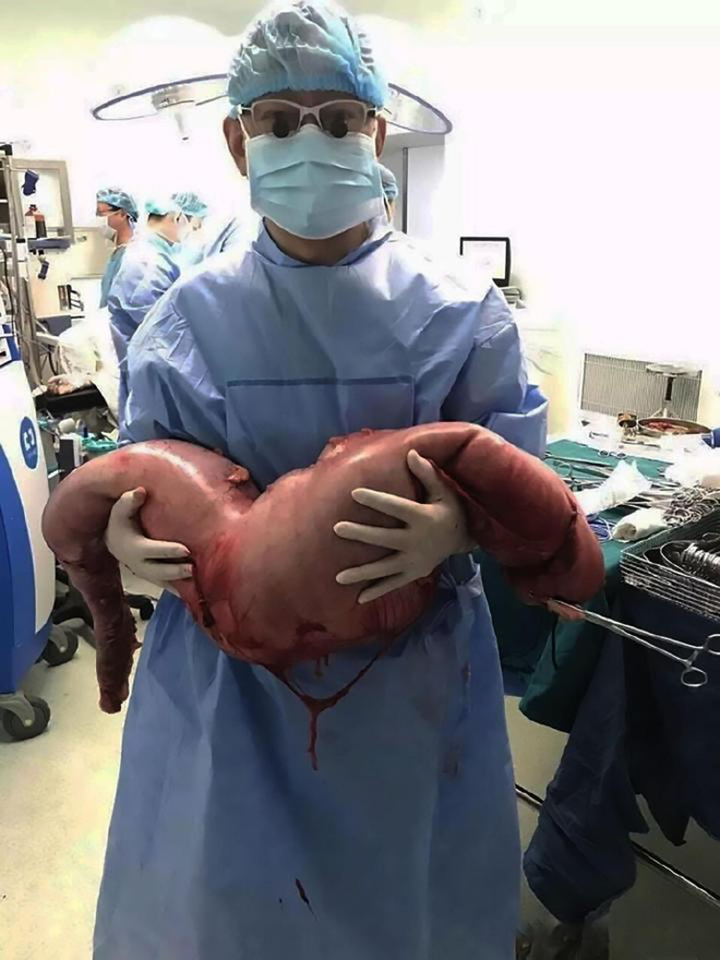 Mổ bụng bệnh nhân, bác sĩ tá hỏa khi phát hiện khối đại tràng dài 76cm do bị táo bón nhiều năm - Ảnh 1.