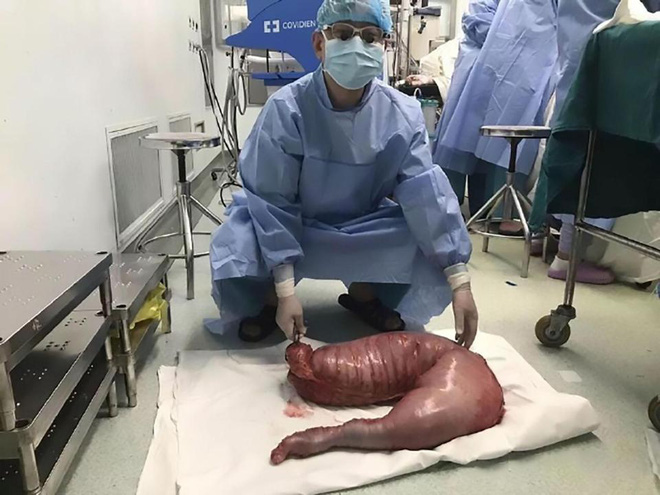 Mổ bụng bệnh nhân, bác sĩ tá hỏa khi phát hiện khối đại tràng dài 76cm do bị táo bón nhiều năm - Ảnh 2.