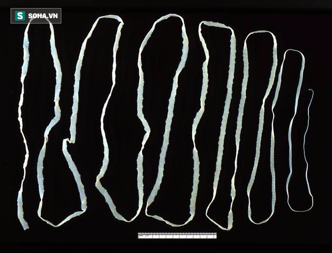 Sán dây dài 2,6 mét ngọ nguậy trong bụng vì ăn món nhiều người thích - Ảnh 2.