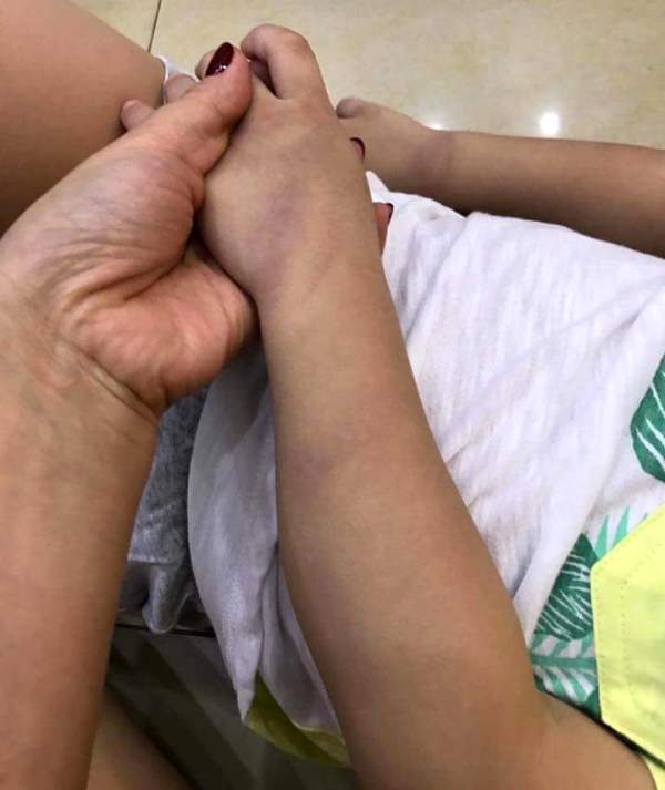 Xôn xao bé trai 3 tuổi ở Hải Dương bị giáo viên đánh bầm tím chân tay