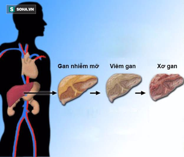 Gan nhiễm mỡ dù nhẹ cũng nguy hiểm: Những triệu chứng cần đến viện kiểm tra ngay - Ảnh 1.