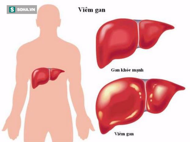 Tổ chức y tế tại Mỹ: 8 dấu hiệu bạn đã mắc căn bệnh thầm lặng rất nguy hiểm cho gan - Ảnh 1.